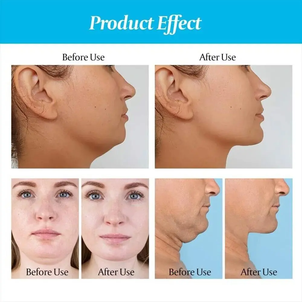 Comparativa "antes y después" de tonificador facial mandíbula, mostrando reducción de papada.