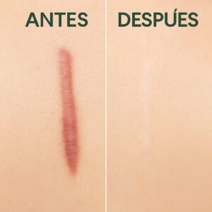 Antes y después de aplicar gel de aloe vera en cicatriz queloide, mostrando reducción de enrojecimiento y relieve.