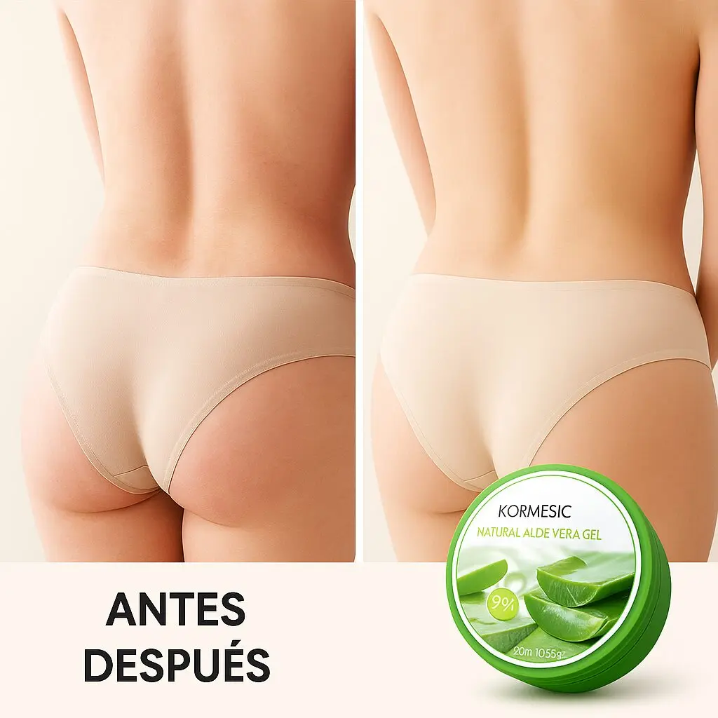 Antes y después: piel de glúteos con celulitis mejorada con gel natural de aloe vera Kormesic 9% 105.5g.