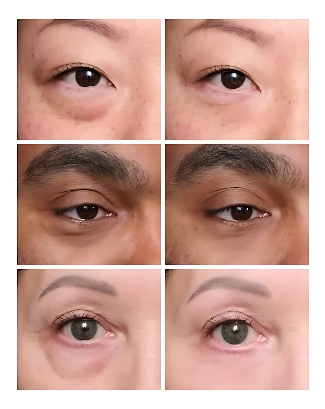 Antes y después: crema tensora antiedad para contorno de ojos, reduce bolsas y ojeras.