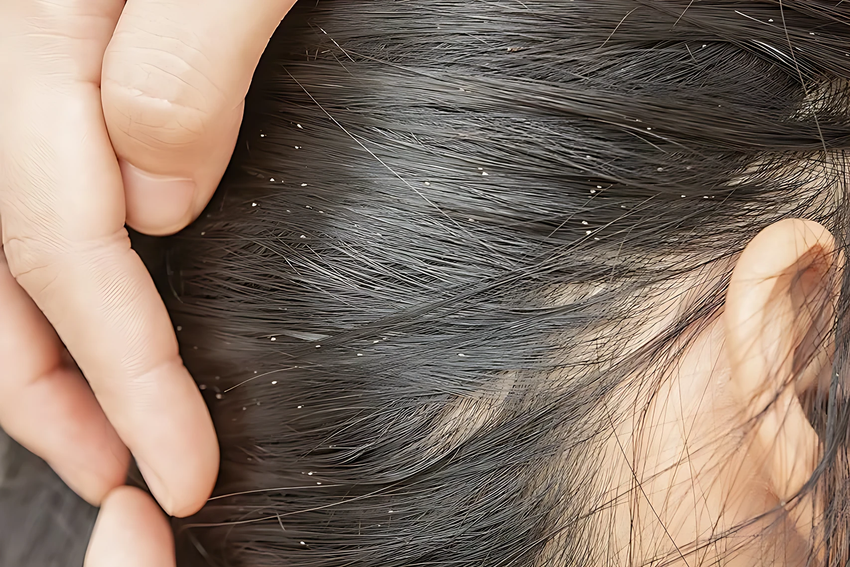 Persona revisando cabello oscuro con piojos y liendres blancos, cerca de la oreja.